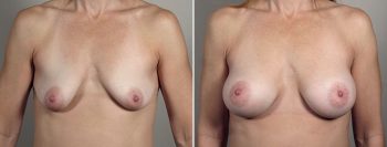 Breast Enlargement (Augmentation) Patient 108