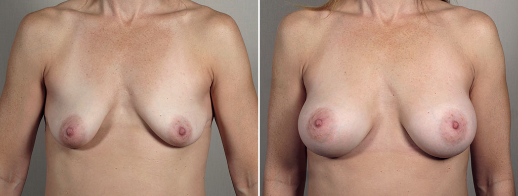 Breast Enlargement (Augmentation) Patient 108