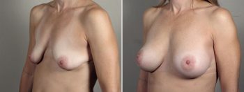 Breast Enlargement (Augmentation) Patient 108