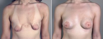 Breast Enlargement (Augmentation) Patient 116
