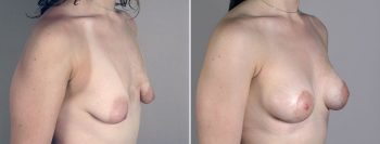 Breast Enlargement (Augmentation) Patient 116
