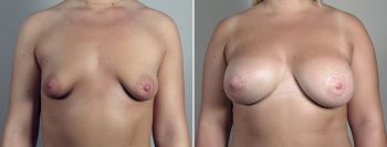 Breast Enlargement (Augmentation) Patient 117