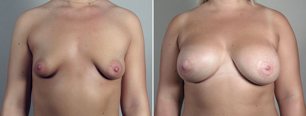 Breast Enlargement (Augmentation) Patient 117