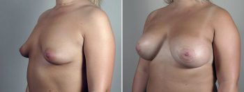 Breast Enlargement (Augmentation) Patient 117