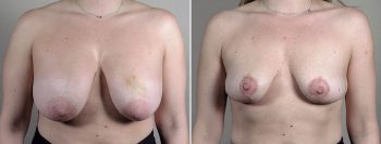 Breast Implant Removal Patient 35