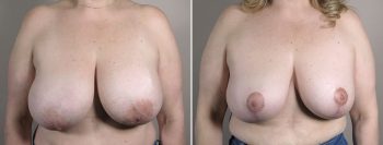 Breast Implant Revision 55