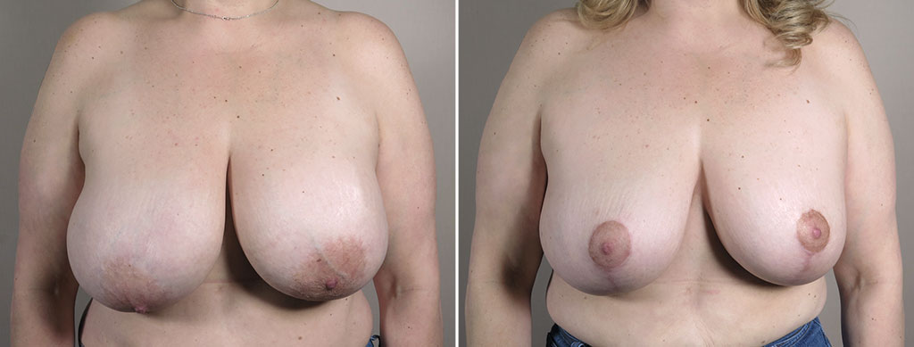 Breast Implant Revision 55