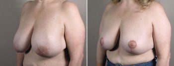 Breast Implant Revision 55