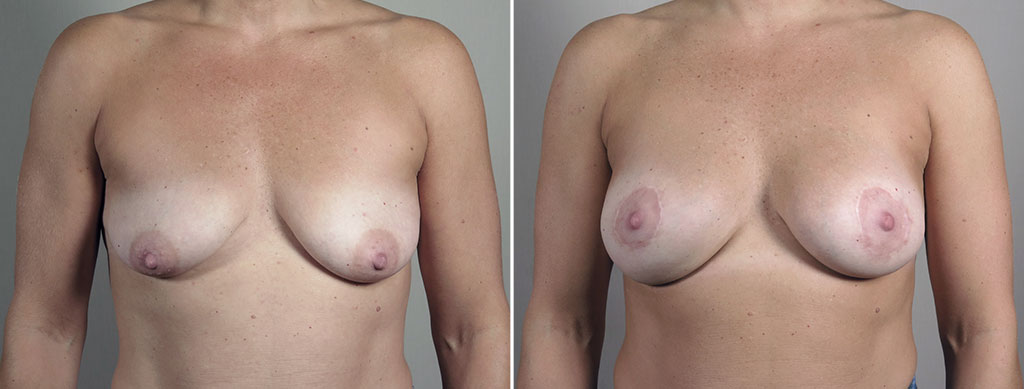 Breast Lift with Augmentation 53