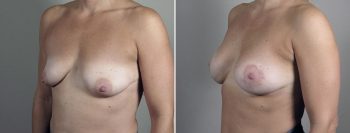 Breast Lift with Augmentation 53