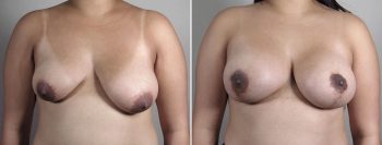 Breast Lift with Augmentation 54