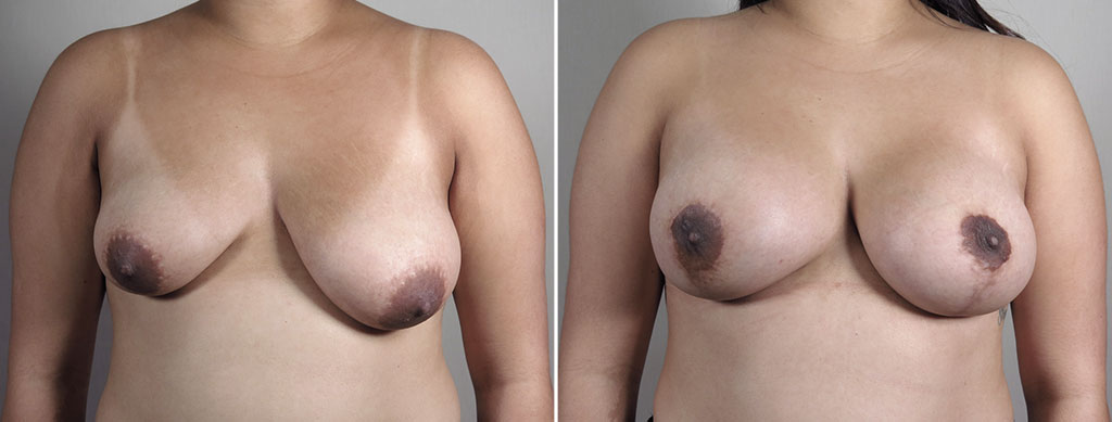 Breast Lift with Augmentation 54