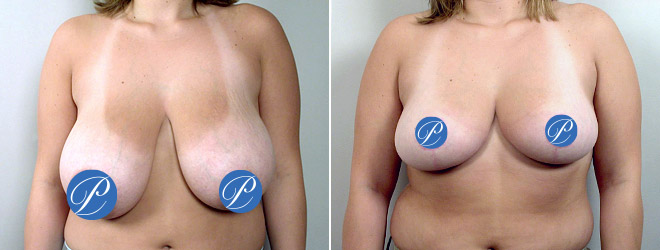 New Jersey Breast Reduction