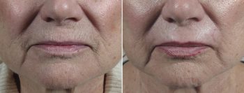 Peri Oral Dermabrasion 8