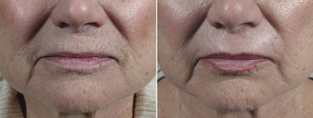 Peri Oral Dermabrasion 8