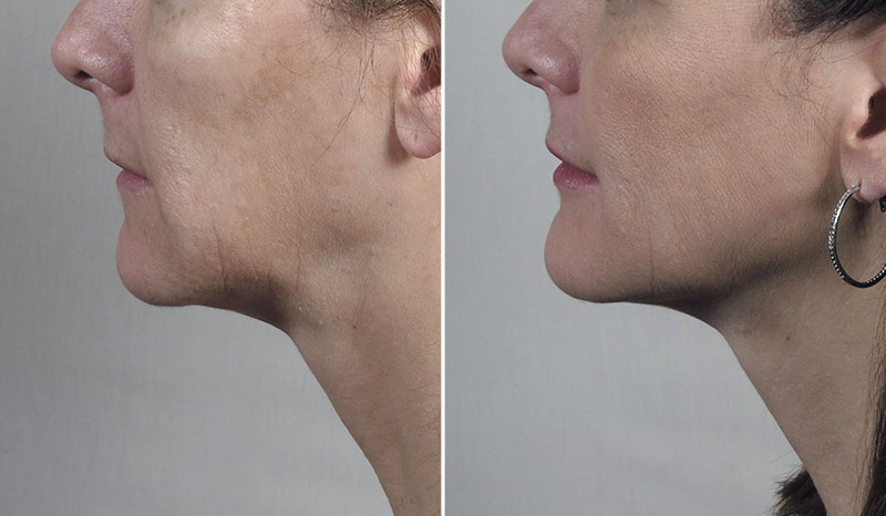 Before & After FaceTite at the Parker Center Before & After FaceTite at the Parker Center