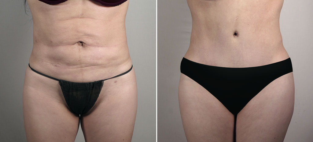 Parker Tummy Tuck Patient 67