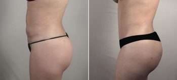 Parker Tummy Tuck Patient 67