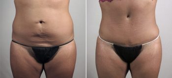 Parker Tummy Tuck Patient 66