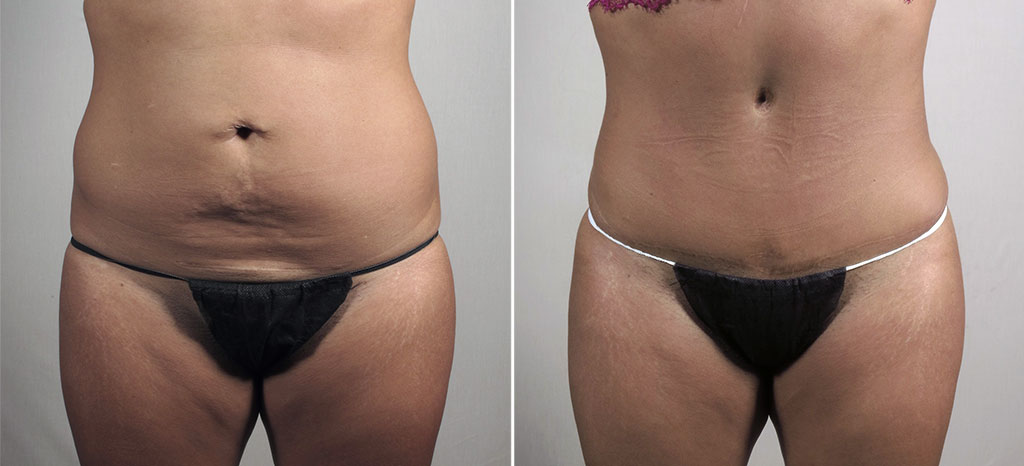 Parker Tummy Tuck Patient 66