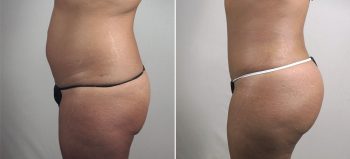 Parker Tummy Tuck Patient 66