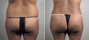 Parker Tummy Tuck Patient 66