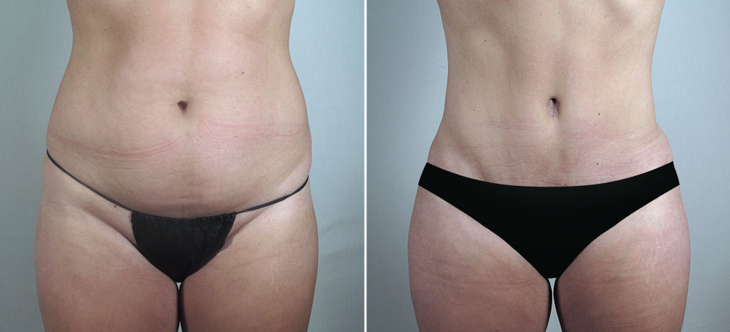 Parker Tummy Tuck & Liposuction of Hips