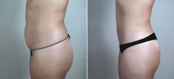 Parker Tummy Tuck & Liposuction of Hips