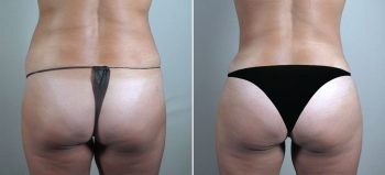 Parker Tummy Tuck & Liposuction of Hips