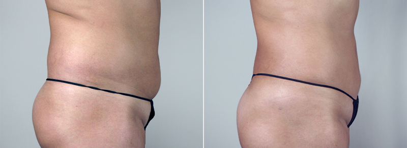 Before & After Liposuction