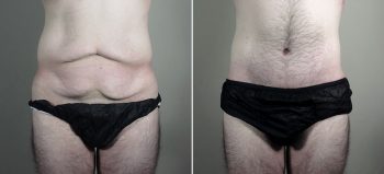 Body Lift with Gynecomastia
