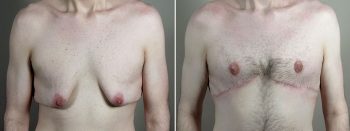 Body Lift with Gynecomastia