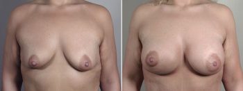 Mommy Makeover Patient 34