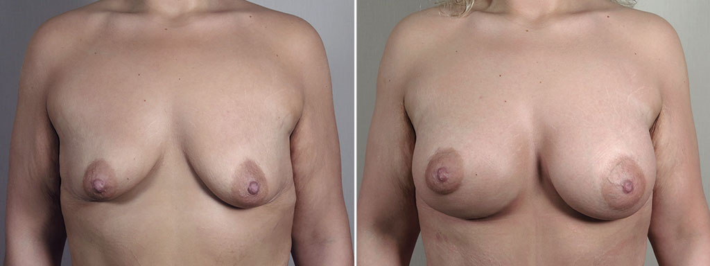 Mommy Makeover Patient 34