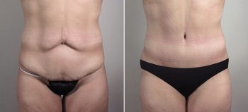 Mommy Makeover Patient 34