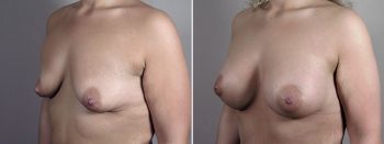 Mommy Makeover Patient 34