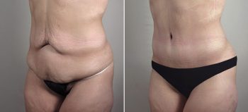 Mommy Makeover Patient 34