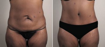 Mommy Makeover Patient 36