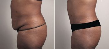 Mommy Makeover Patient 36