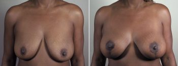 Mommy Makeover Patient 36