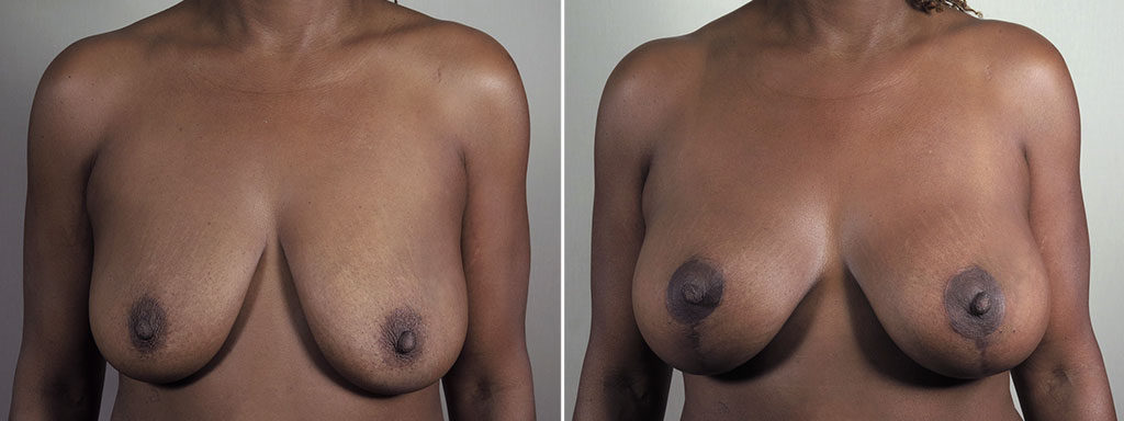 Mommy Makeover Patient 36