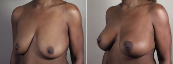 Mommy Makeover Patient 36