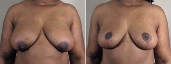 Mommy Makeover Patient 35