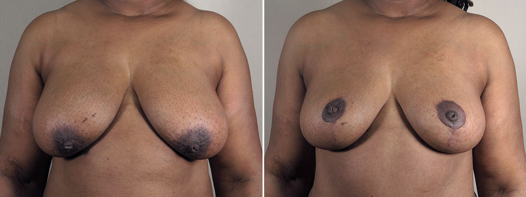 Mommy Makeover Patient 35