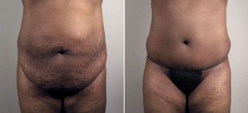 Mommy Makeover Patient 35