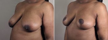 Mommy Makeover Patient 35