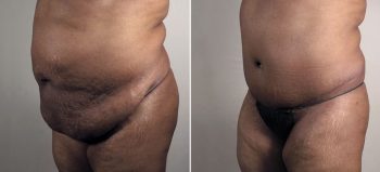 Mommy Makeover Patient 35