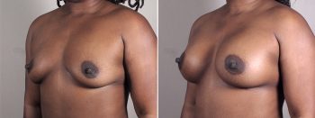 Mommy Makeover Patient 37