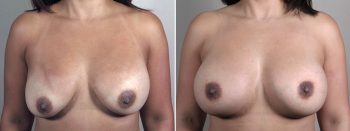 Mommy Makeover Patient 38