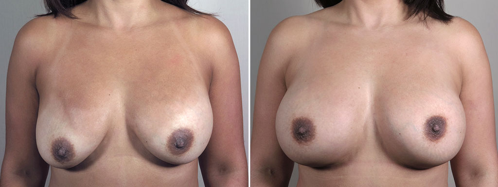 Mommy Makeover Patient 38